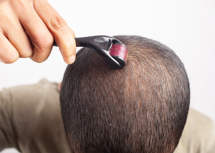 scalp microneedling in Delhi
